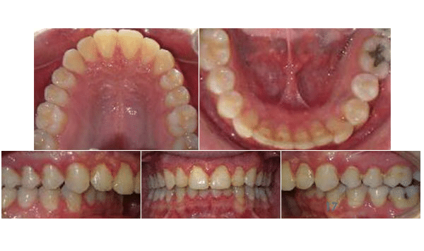Clear Aligners