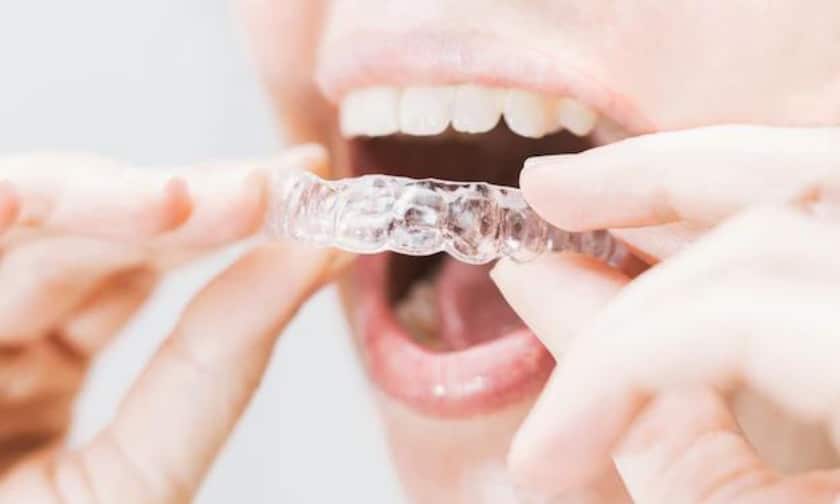 How Is Invisalign For Teens Different From Invisalign For Adults?
